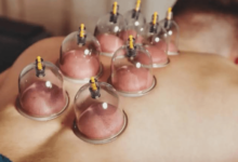 Discover the Healing Benefits of Hijama in Sydney at Alchemist Remedial Clinic