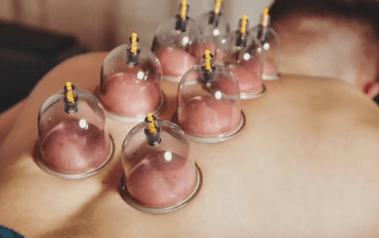 Discover the Healing Benefits of Hijama in Sydney at Alchemist Remedial Clinic